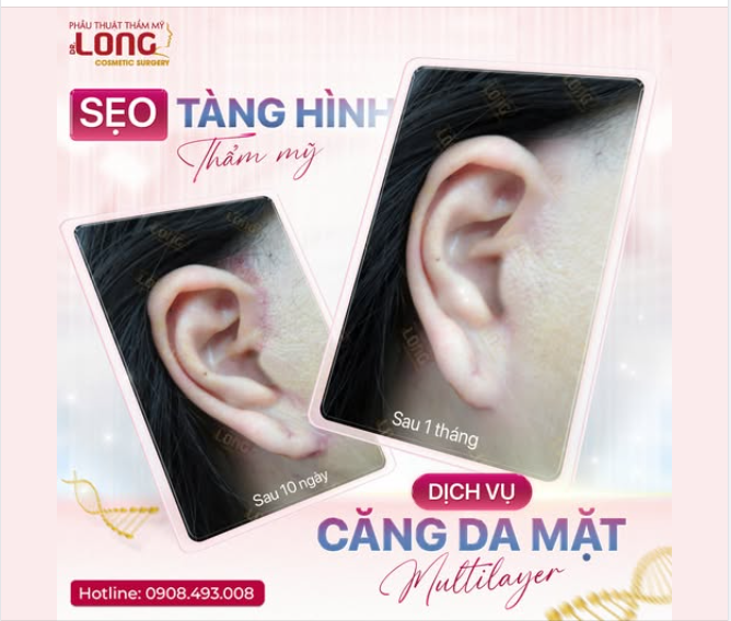 MUỐN LÀM ĐẸP NHƯNG NGẠI “SẸO”