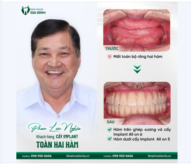 Trồng răng Implant - Nâng cấp nụ cười, nâng tầm cuộc sống