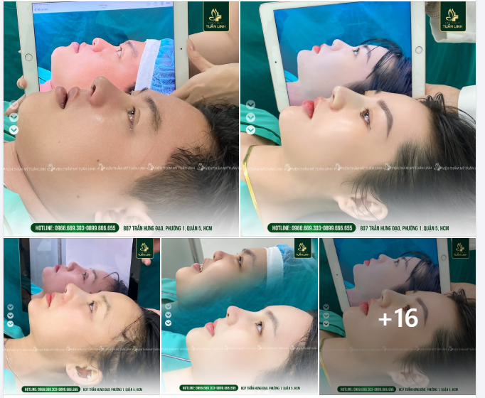 20 CA NÂNG MŨI TRONG NGÀY TẠI TUẤN LINH!!