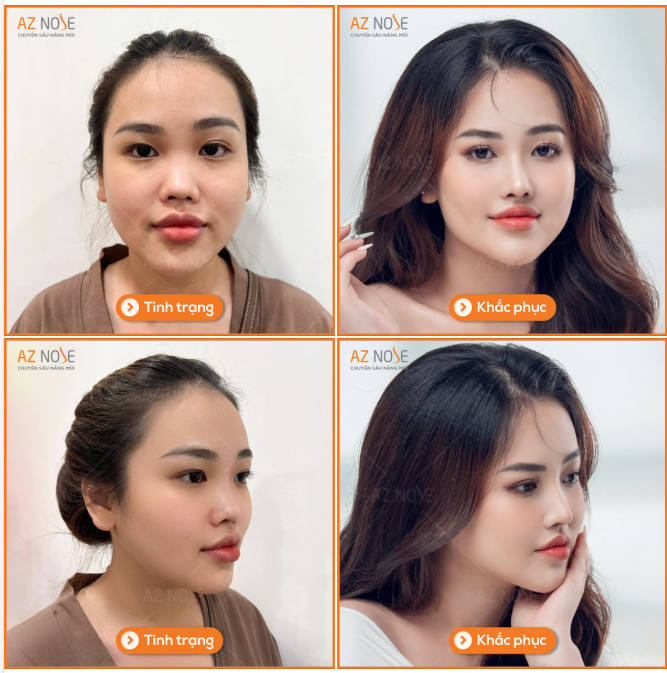 Từ chiếc mũi sụp một bên gây khó thở đến dáng Sline thanh tú sau 3 tháng