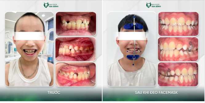 Mẹ ơi! Răng con thế này, bác sĩ bảo phải tiền chỉnh nha mẹ nhé!