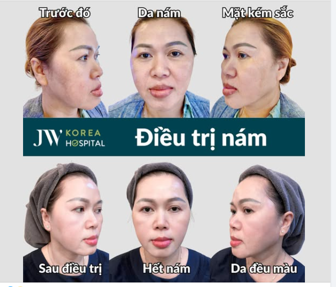 KHẮC PHỤC 95% NÁM, LẤY LẠI LÀN DA KHÔNG TÌ VẾT CHỈ SAU 1 LIỆU TRÌNH TẠI JW KHIẾN CHỊ EM MÊ MẨN