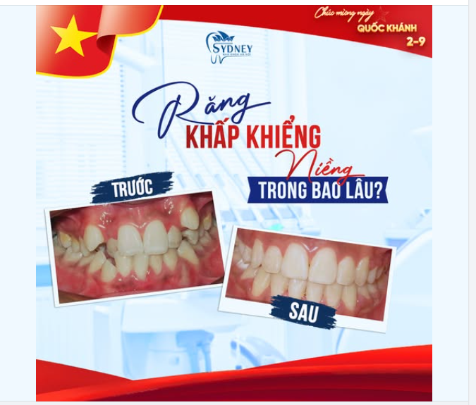 RĂNG KHẤP KHỂNH NIỀNG TRONG BAO LÂU?