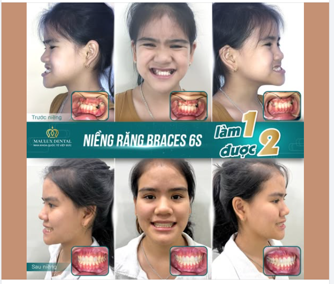 KHỚP CẮN NGƯỢC – NIỀNG RĂNG CÀNG SỚM, HIỆU QUẢ CÀNG CAO