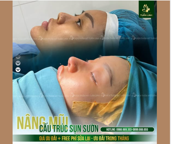 NÂNG MŨI CẤU TRÚC SỤN SƯỜN - ĐẸP HOÀN HẢO - FREE NGAY PHÍ SỬA LẠI!!