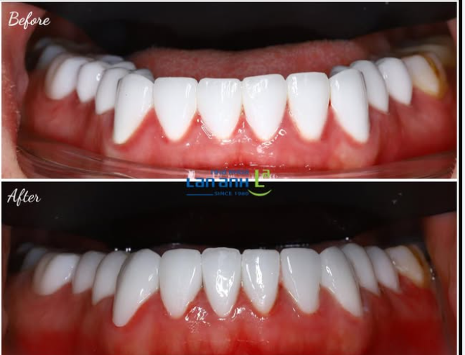 Trong hình là 1 ca Veneer sứ làm không tốt, gây viêm nướu chảy máu liên tục, được làm lại tại nha khoa Lan Anh ạ