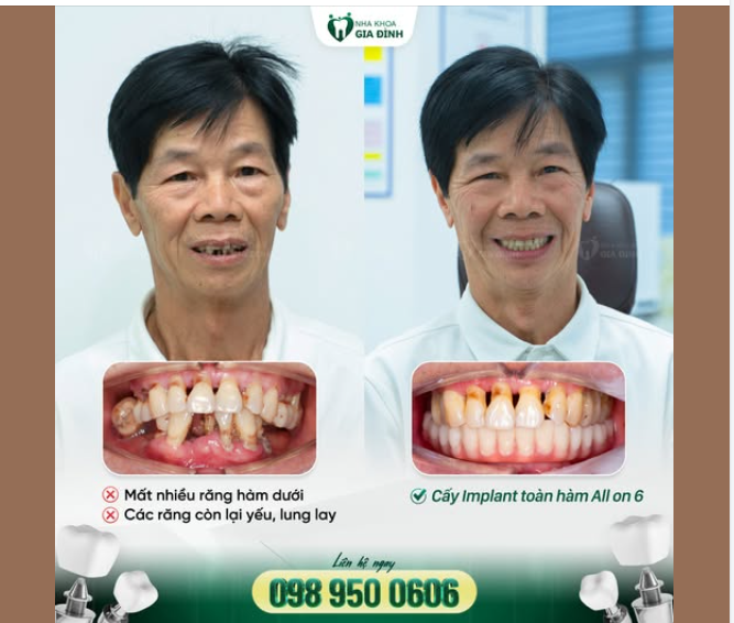 Trồng Implant - Ăn ngon sống khỏe, an hưởng tuổi già