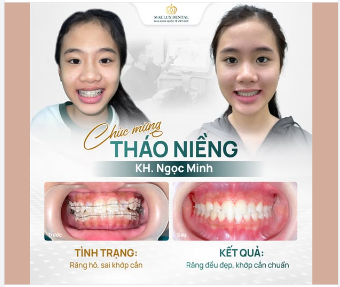 Minh ngày xưa răng hô, khấp khểnh, lệch khớp cắn.
