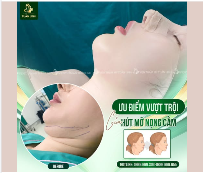 ƯU ĐIỂM VƯỢT TRỘI CỦA HÚT MỠ NỌNG CẰM!!