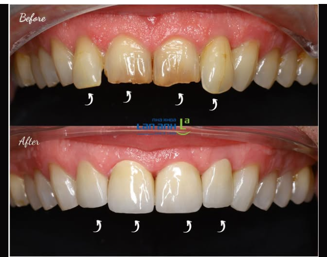 Đôi khi chỉ cần thay vài chiếc răng sứ, kết quả đạt được là rất khác biệt