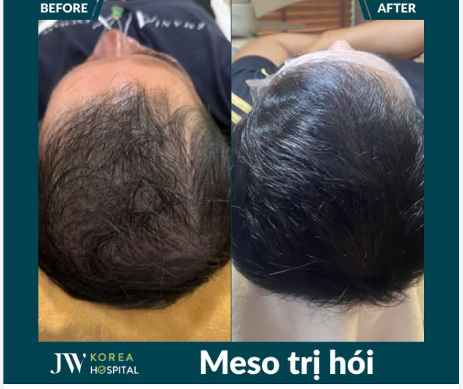U50 - U80 LẤY LẠI SỰ TỰ TIN VỚI MÁI TÓC DÀY ĐẸP NHỜ MESO TRỊ HÓI TẠI JW