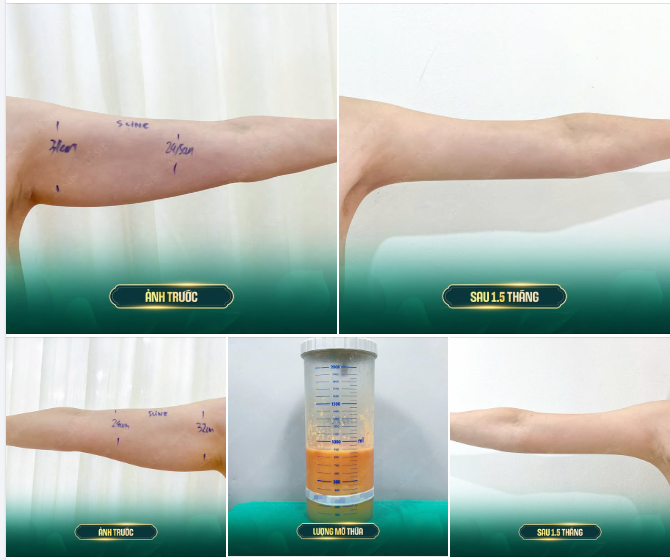 SAU 1,5 THÁNG HÚT MỠ CÁNH TAY