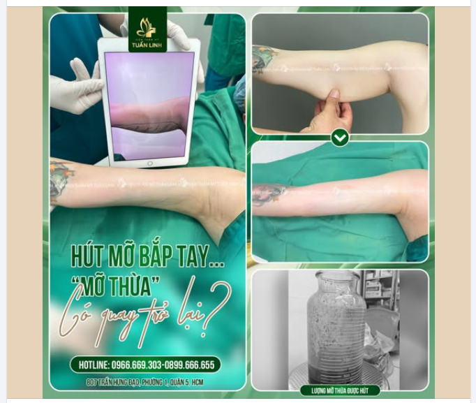 Hút mỡ bắp tay - ''mỡ thừa'' có quay trở lại??