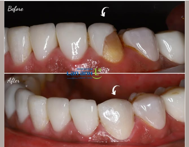 Veneer siêu mỏng làm tại nơi khác, sau một thời gian sử dụng thì bị bể ạ