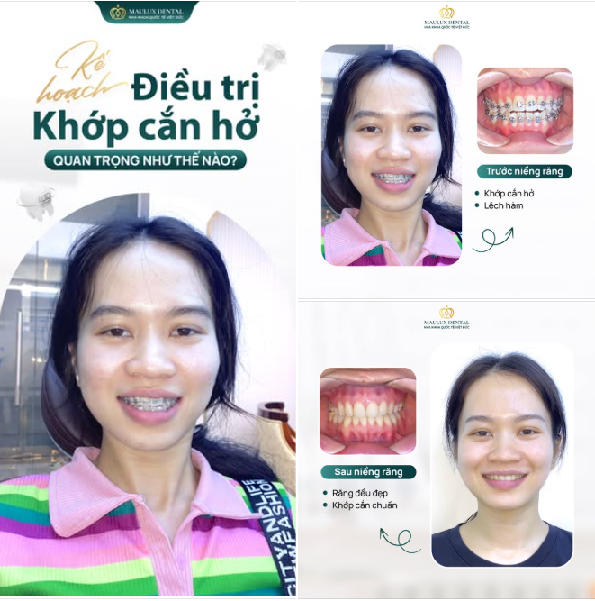 TẠM BIỆT KHỚP CẮN HỞ - CHÀO NỤ CƯỜI TỰ TIN!