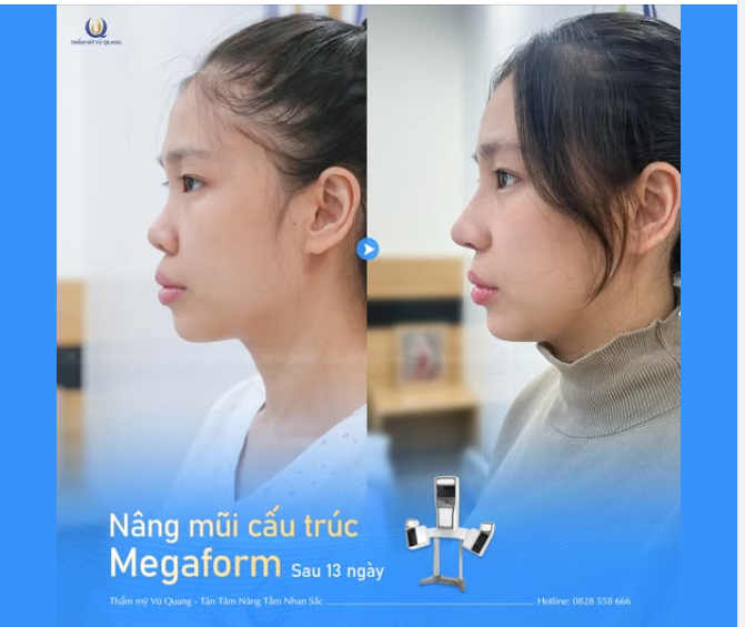 13 NGÀY NÂNG MŨI CẤU TRÚC – LỘ DIỆN DÁNG MŨI ĐẸP THẦN THÁNH!
