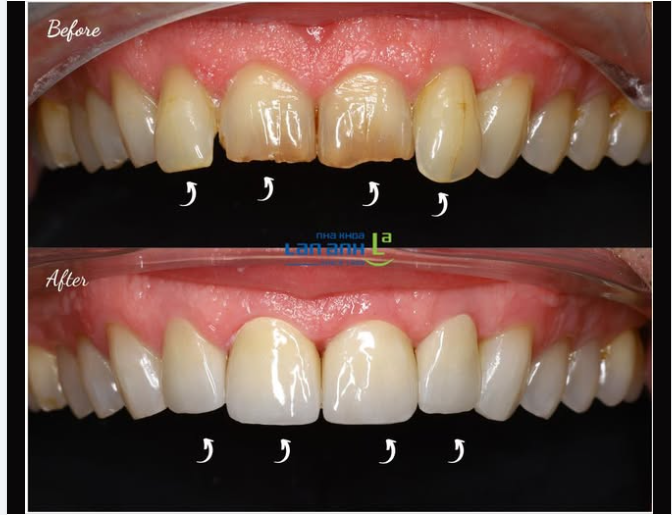 Đôi khi chỉ cần thay vài chiếc răng sứ, kết quả đạt được là rất khác biệt