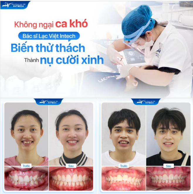 RĂNG GIAN NAN - CÓ BÁC SĨ LẠC VIỆT INTECH XẾP LẠI THẲNG HÀNG