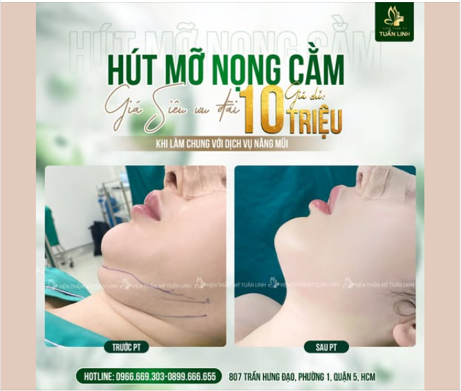 Hút mỡ nọng cằm giá chỉ 10TR khi làm chung với dịch vụ nâng mũi!!