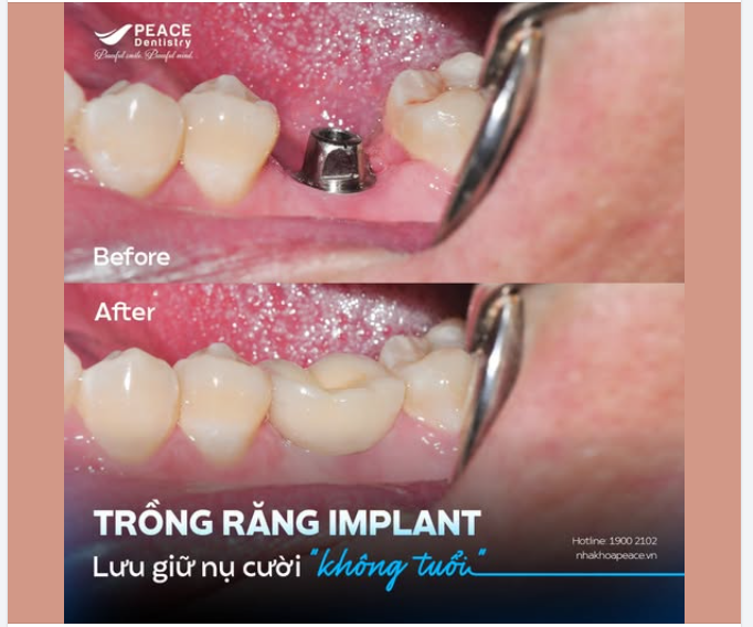ĐỪNG ĐỂ VIỆC MẤT RĂNG "CƯỚP" ĐI NỤ CƯỜI VÀ SỰ TRẺ TRUNG CỦA BẠN