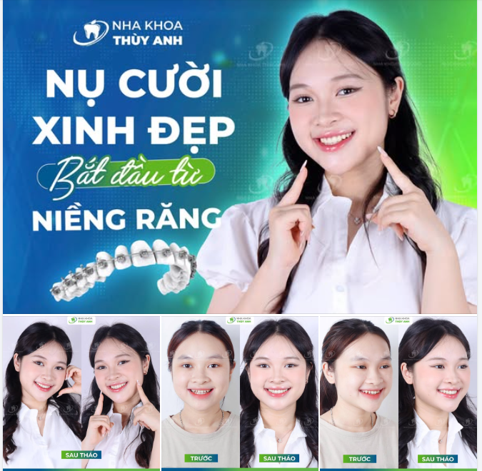 NIỀNG RĂNG THƯA GIÚP NỤ CƯỜI THÊM PHẦN RẠNG RỠ