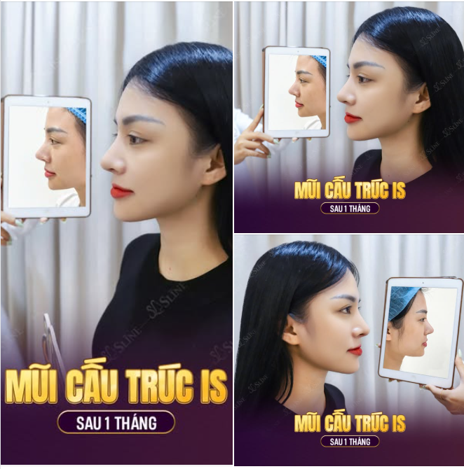 NÂNG MŨI CẤU TRÚC IS – CHUYỂN MÌNH SAU 1 THÁNG