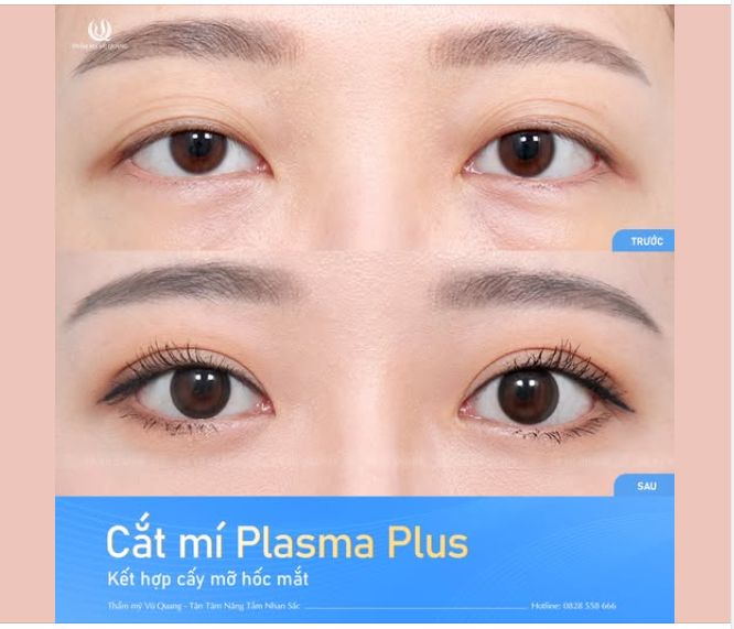 Đôi mắt thay đổi 180 độ - Từ nếp mí mờ nhạt đến ánh nhìn tự tin - tươi trẻ trong diện mạo mới