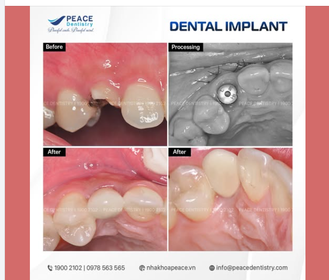 Kết quả điều trị sau cùng khôi phục rất tốt về cả chức năng và thẩm mỹ nụ cười.