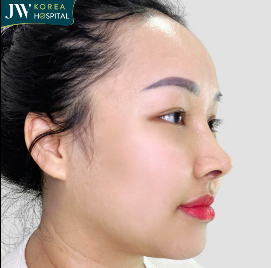 NÂNG MŨI S LINE TẠI JW - GIẢI PHÁP LÝ TƯỞNG GIÚP VIỆT KIỀU SỞ HỮU DÁNG MŨI ĐẸP CHUẨN Á ĐÔNG