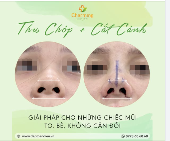 THU CHÓP VÀ CẮT CÁNH – GIẢI PHÁP CHO MŨI THON GỌN