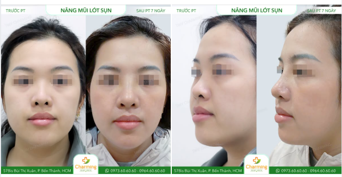 Chỉ sau 7 ngày, đường nét đã ổn định và gương mặt cũng hài hòa hơn.