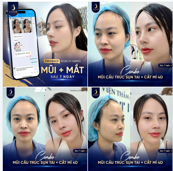 COMBO MŨI VÀ MÍ GIÚP GƯƠNG MẶT KHÍ CHẤT HƠN HẲN