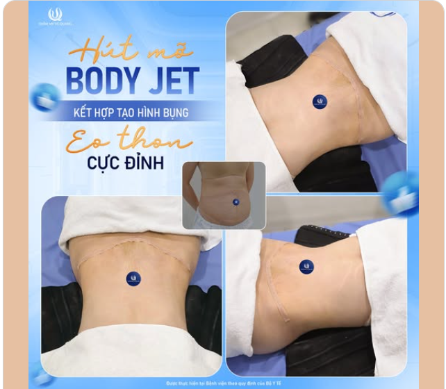 TÁI SINH BỤNG MỠ – MÓN QUÀ TUYỆT VỜI CHO CHÍNH MÌNH