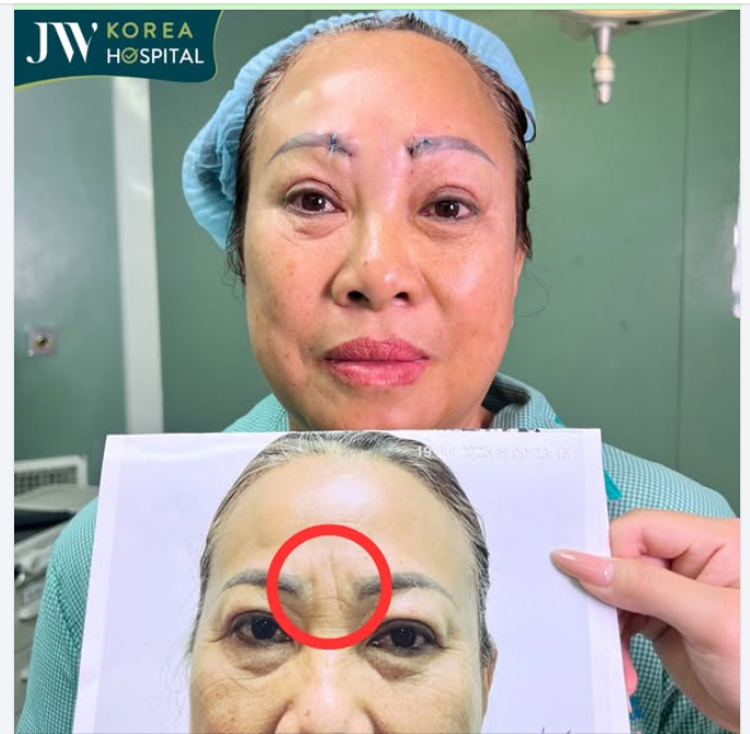 TREO CHÂN MÀY NỘI SOI 4X - CÓ ĐÔI MẮT TRẺ 0 TUỔI CHỈ TRONG TÍCH TẮC