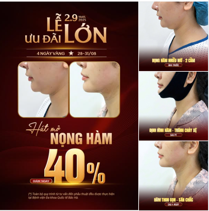 4 NGÀY VÀNG – HÚT MỠ NỌNG HÀM GIẢM 40%