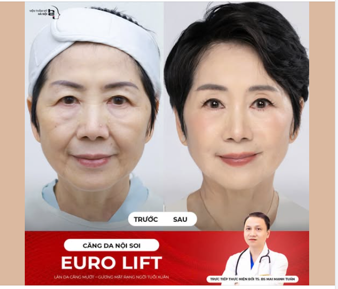CĂNG DA NỘI SOI EURO LIFT