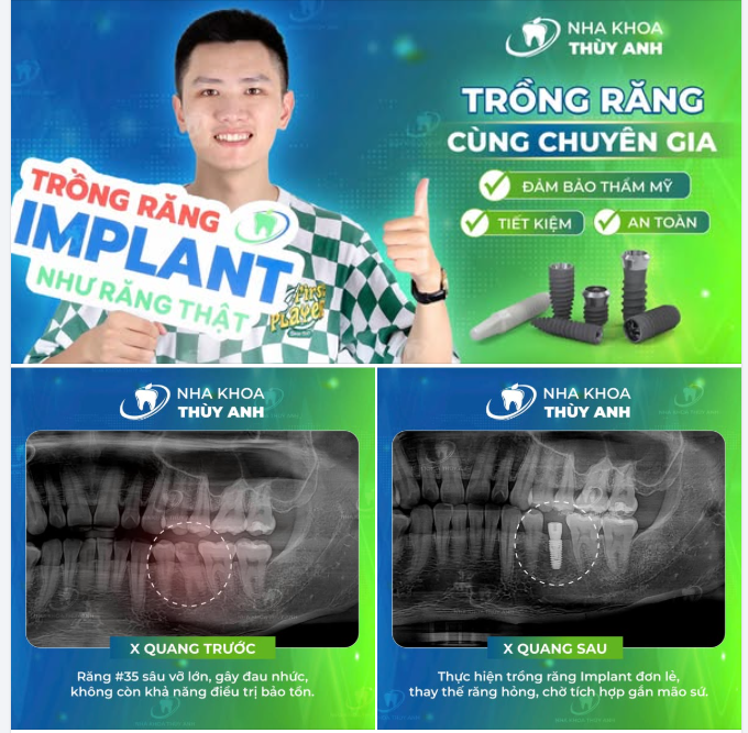 NHỔ BỎ RĂNG HỎNG - TRỒNG IMPLANT TỨC THÌ KHÔI PHỤC CHỨC NĂNG ĂN NHAI