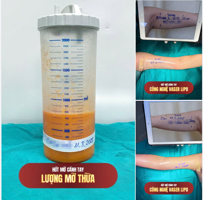 CÁNH TAY THON GỌN – TỰ TIN KHOE DÁNG