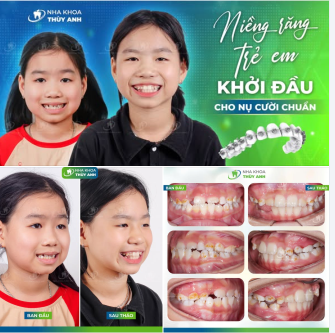 NIỀNG RĂNG - KHÔNG GIỚI HẠN ĐỘ TUỔI, CHỈ CẦN ĐÚNG THỜI ĐIỂM