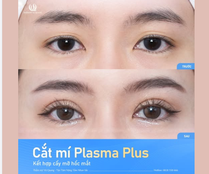 Sau 1 tháng cắt mí, đôi mắt của bạn ấy đã thực sự “lên hạng”