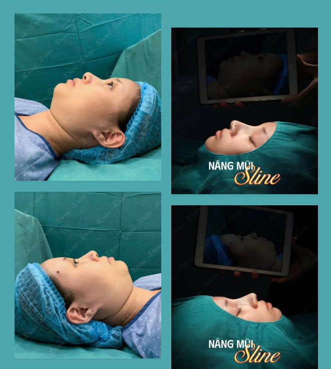 NÂNG MŨI SLINE – LỘT XÁC NGOẠN MỤC, ĐẸP NGAY THÁNG 8