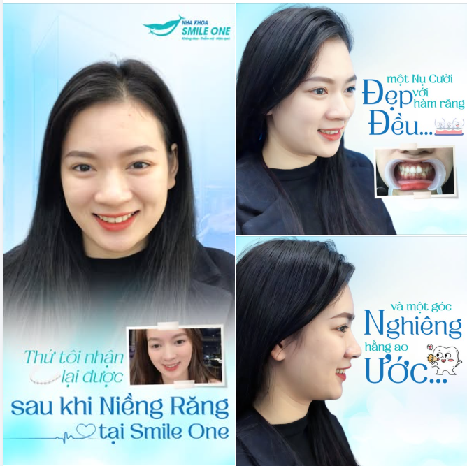 Trải nghiệm dịch vụ nha khoa không đau - không khó chịu - tận tâm từ Smile One!