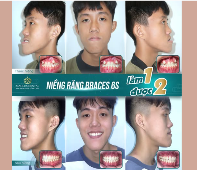 TẠM BIỆT "MẶT LƯỠI CÀY" - CHÀO ĐÓN NỤ CƯỜI MỚI