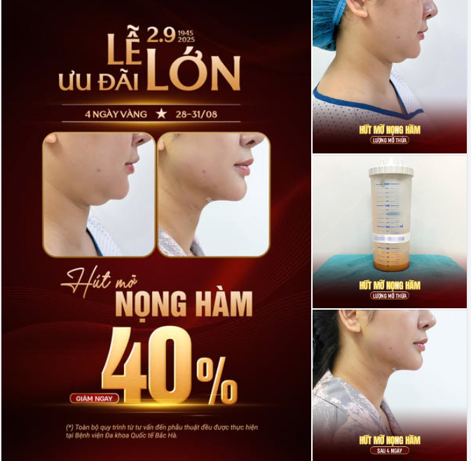 HÚT MỠ NỌNG HÀM – ƯU ĐÃI 40% TRONG 4 NGÀY VÀNG
