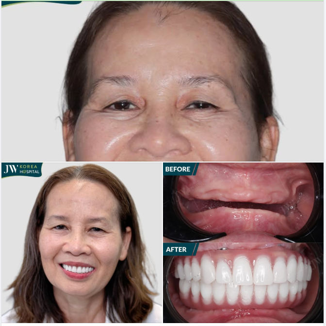 QUÝ CÔ VIỆT KIỀU MỸ U70 TRẺ LẠI HƠN 20 TUỔI CHỈ SAU 1 LẦN CẤY GHÉP IMPLANT TOÀN HÀM TẠI JW