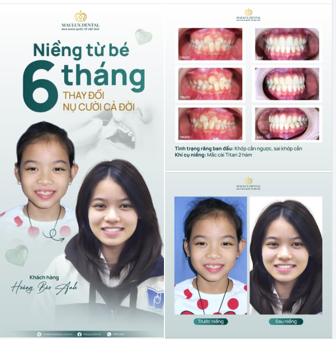 NIỀNG RĂNG TỪ BÉ – MÓN QUÀ YÊU THƯƠNG THAY ĐỔI CẢ ĐỜI