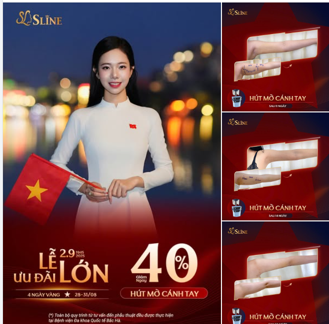 GIẢM 40% HÚT MỠ CÁNH TAY – 4 NGÀY VÀNG