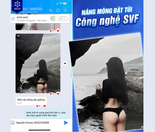 Đặt túi độn kết hợp mỡ tự thân và yếu tố SVF tạo nên vòng 3 cực phẩm