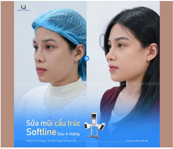 Bí quyết của cô nàng M.H chính là  Sửa mũi Softline – công nghệ đỉnh cao giúp tái cấu trúc toàn bộ dáng mũi, khắc phục mọi khuyết điểm và đem lại form mũi chuẩn tỉ lệ vàng.
