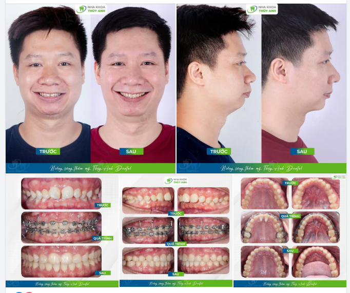 NHA KHOA THÙY ANH CHINH PHỤC CA CHỈNH NHA KHÓ HIẾM GẶP